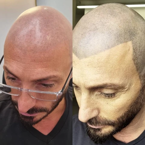 הסרת הדמיית שיער בראש – המדריך המלא